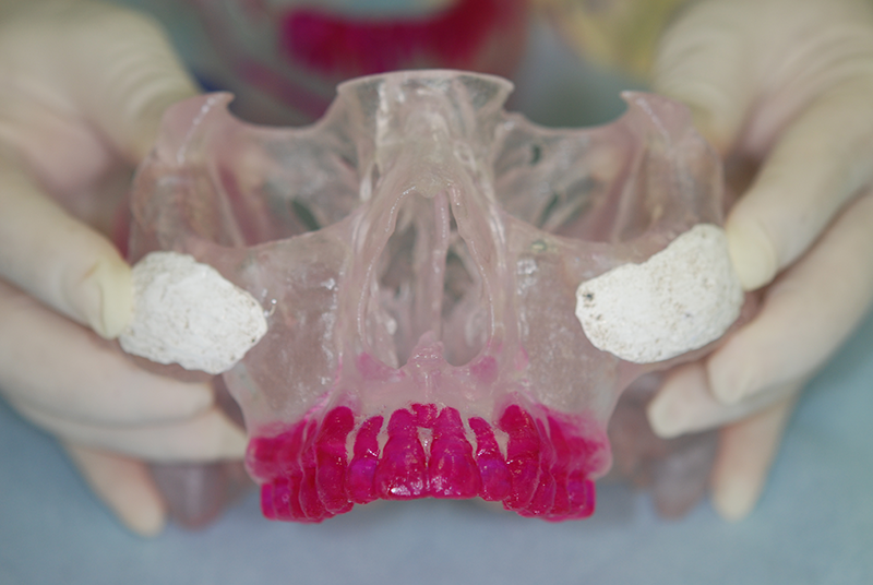 3Dプリント模型を使用してインプラントする人工骨(バイオペックス)のカスタマイズを行う
