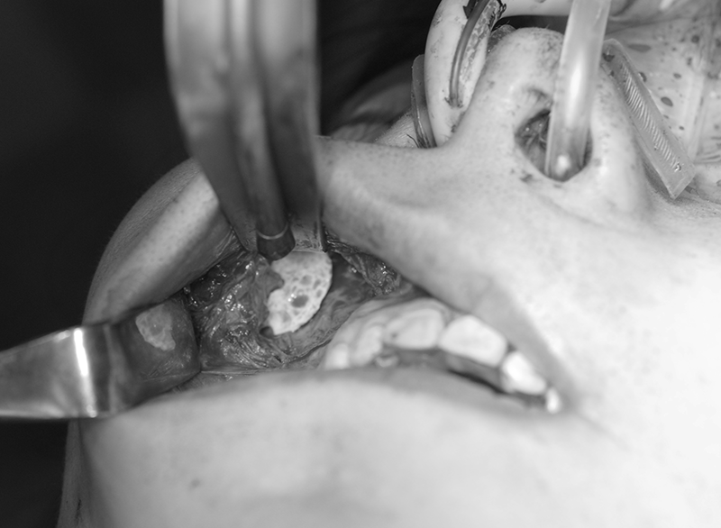 人工骨（バイオペックス）による頬の増大手術