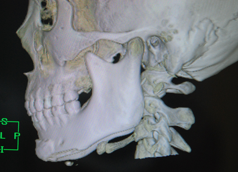 ペースト状ハイドロキシアパタイト製剤(人工骨)を使った頤形成の術後症例