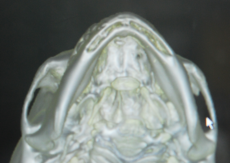 ペースト状ハイドロキシアパタイト製剤(人工骨)を使った頤形成の術前症例