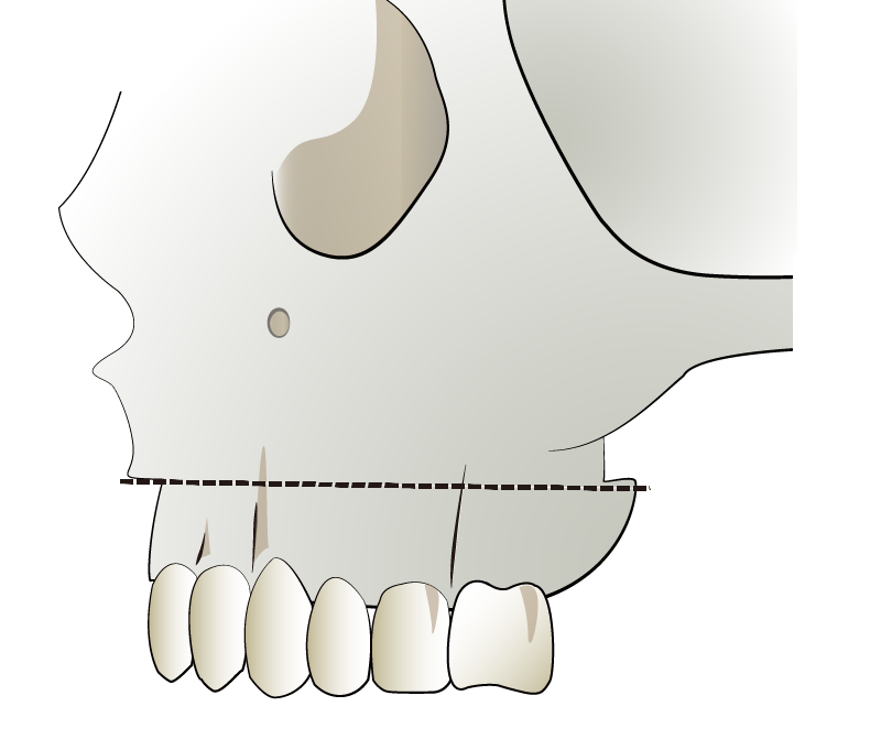 ルフォー1型骨切り術 | 上顎と上歯槽骨の間の骨切りを行う1