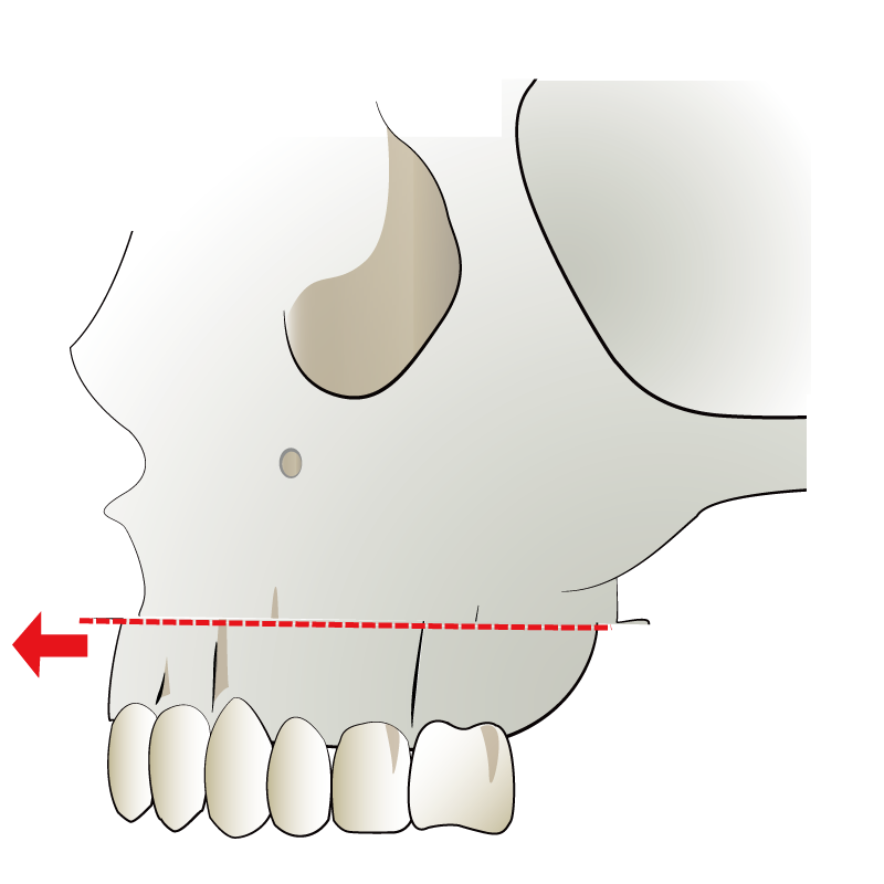ルフォー1型骨切り術 | 切った上歯槽骨を手前に移動して上の歯列を前に移動する