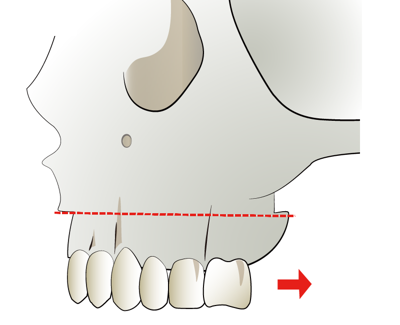ルフォー1型骨切り術 | 切った上歯槽骨を奥に移動して上の歯列を奥に移動する