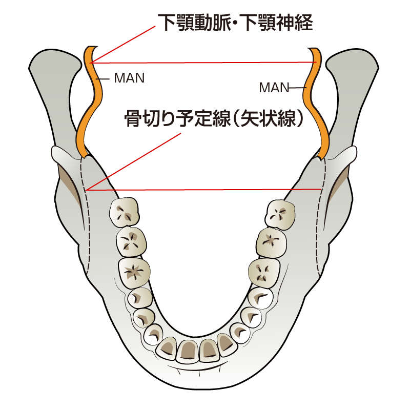 SSRO(Sagittal Split Ramus Osteotomy)下顎枝矢状分割術 | ボーンソウ（電動骨切り機）にて骨をはがし分割するように（スプリット）下顎骨を切り、コツのみで分離させる。