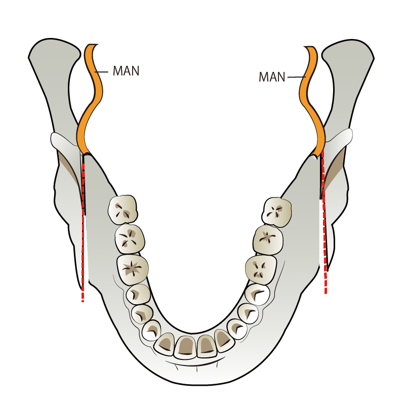 SSRO | 分離した歯槽骨を含む下顎骨片を後方に移動
