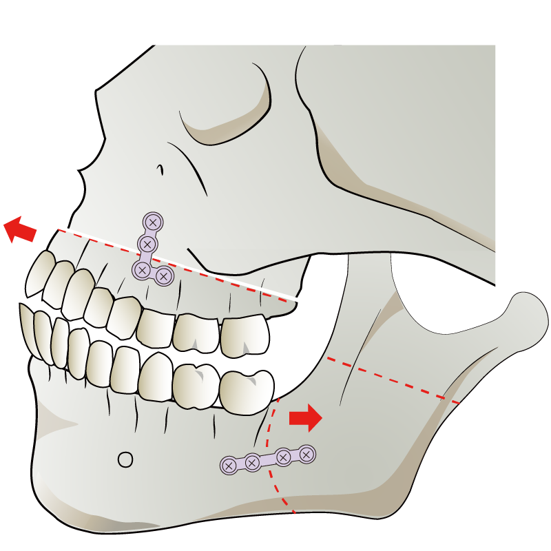 SSRO(Sagittal Split Ramus Osteotomy)下顎枝矢状分割術 | ボーンソウ（電動骨切り機）にて骨をはがし分割するように（スプリット）下顎骨を切り、コツのみで分離させる。