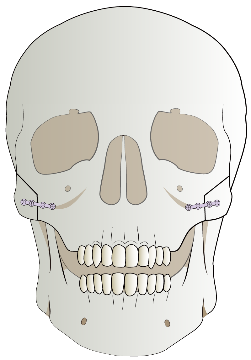 頬骨の内側移動と固定 正面