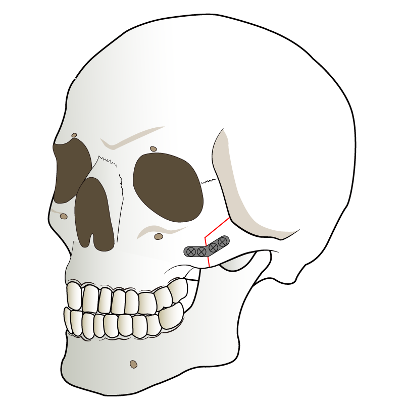 頬骨の内側移動と固定 横側