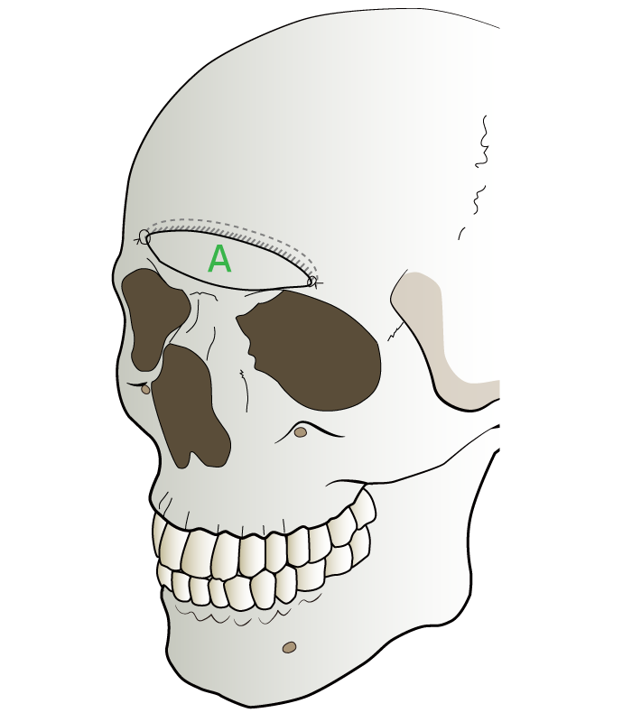 前頭骨にきれいなカーブを描くようにバイオペックス（人工骨）で形を作る