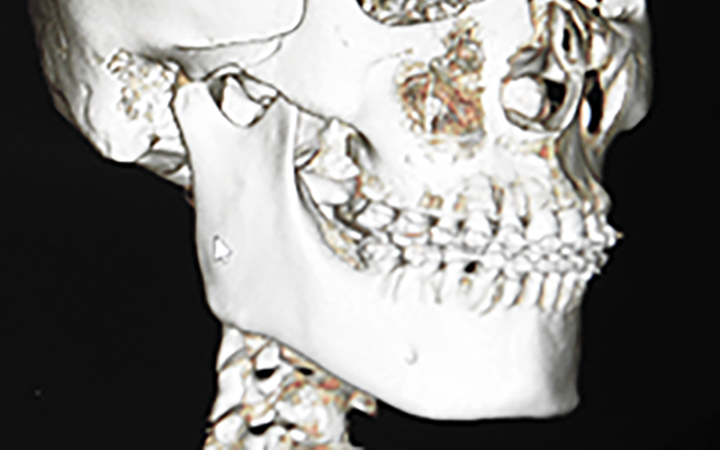 ペースト状ハイドロキシアパタイト製剤(人工骨)を使った頤形成手術 術前の3DCTの撮影