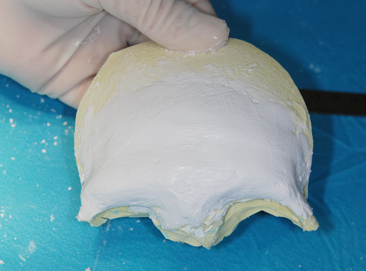 3Dモデルに人工骨を成形