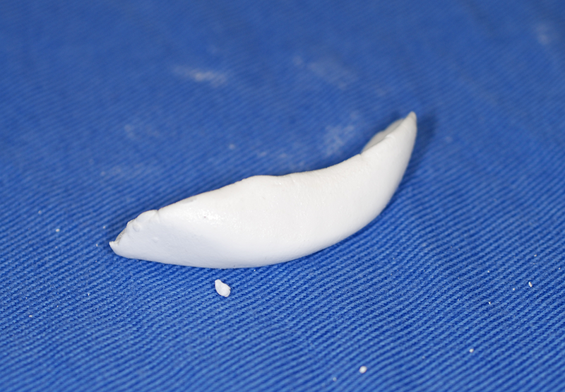 硬化した硬化したペースト状ハイドロキシアパタイト製剤(人工骨)