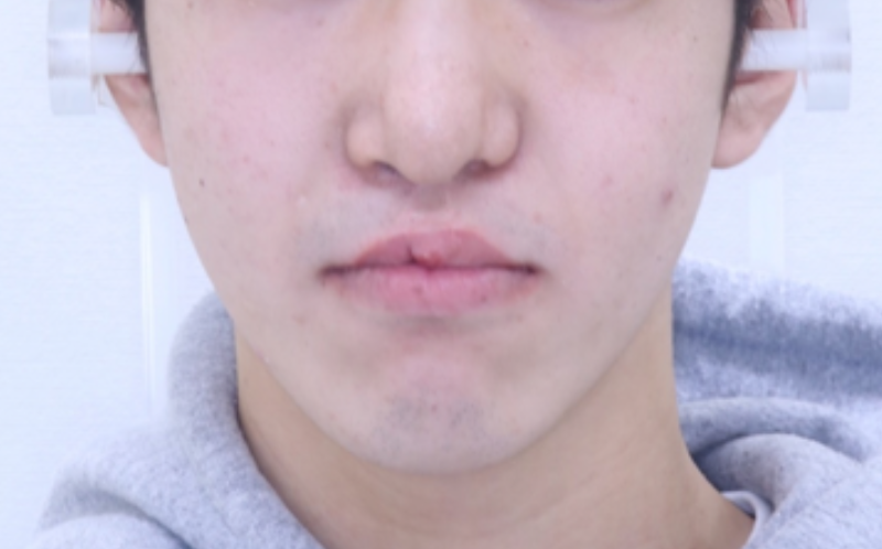 典型的な下顎前突の症例 | 術後