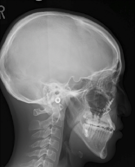 典型的な下顎前突の症例 | 術後