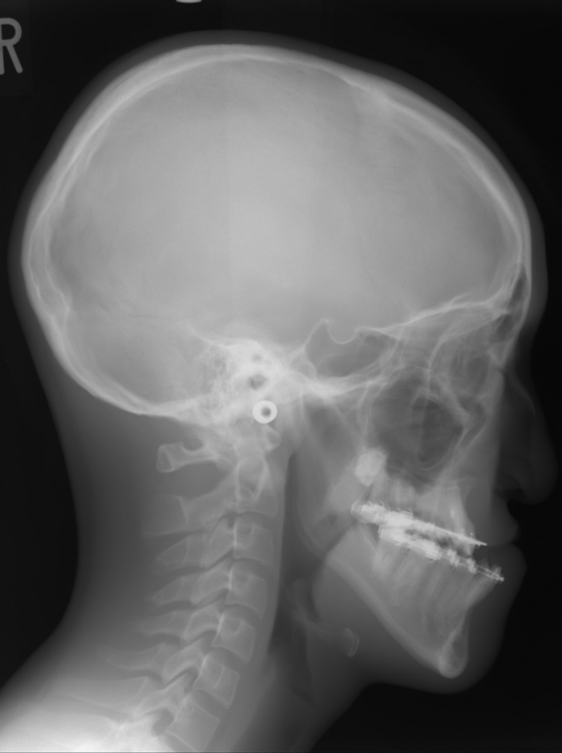 典型的な下顎前突の症例 | 術前