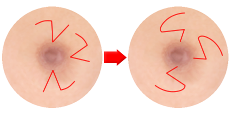 陥没乳頭の手術の模式図