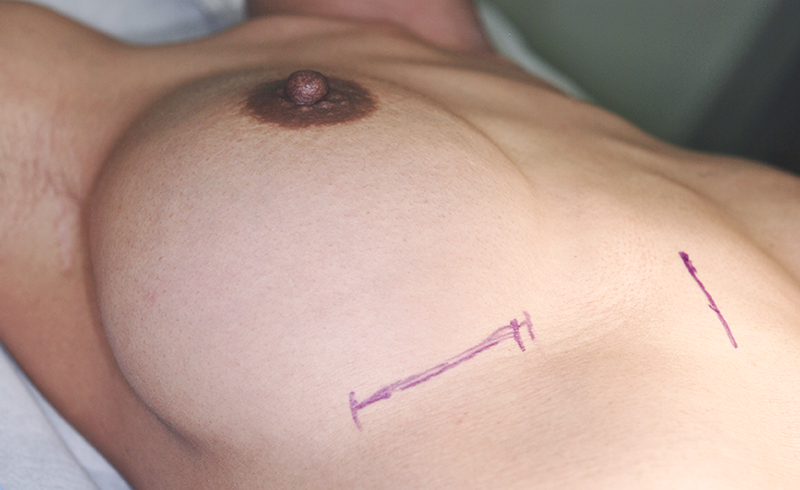 豊胸プロテーゼ除去時の乳房下線での切開