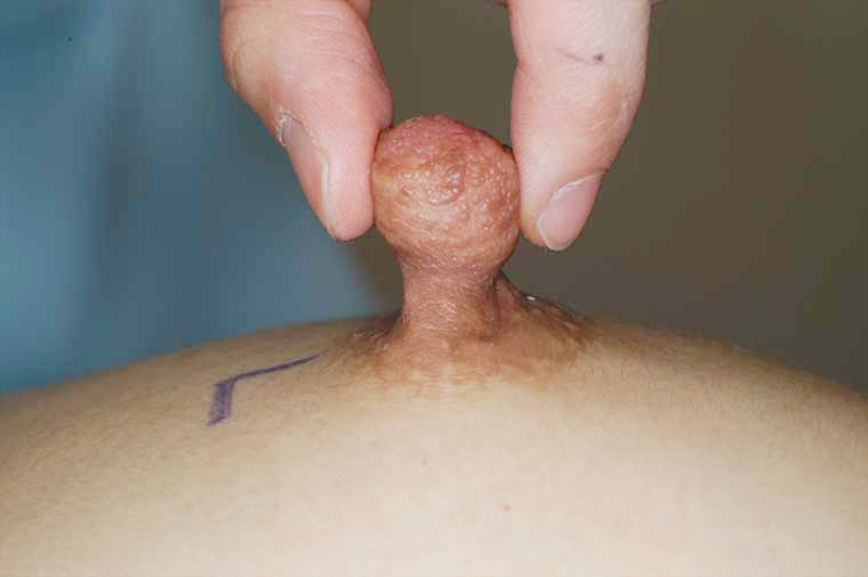 乳頭縮小術の術前症例