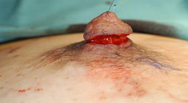 乳頭縮小の手術 乳頭基部の皮膚を円周状に切除