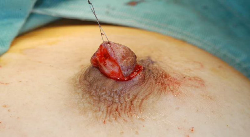 乳頭縮小の手術 乳頭の組織を切除