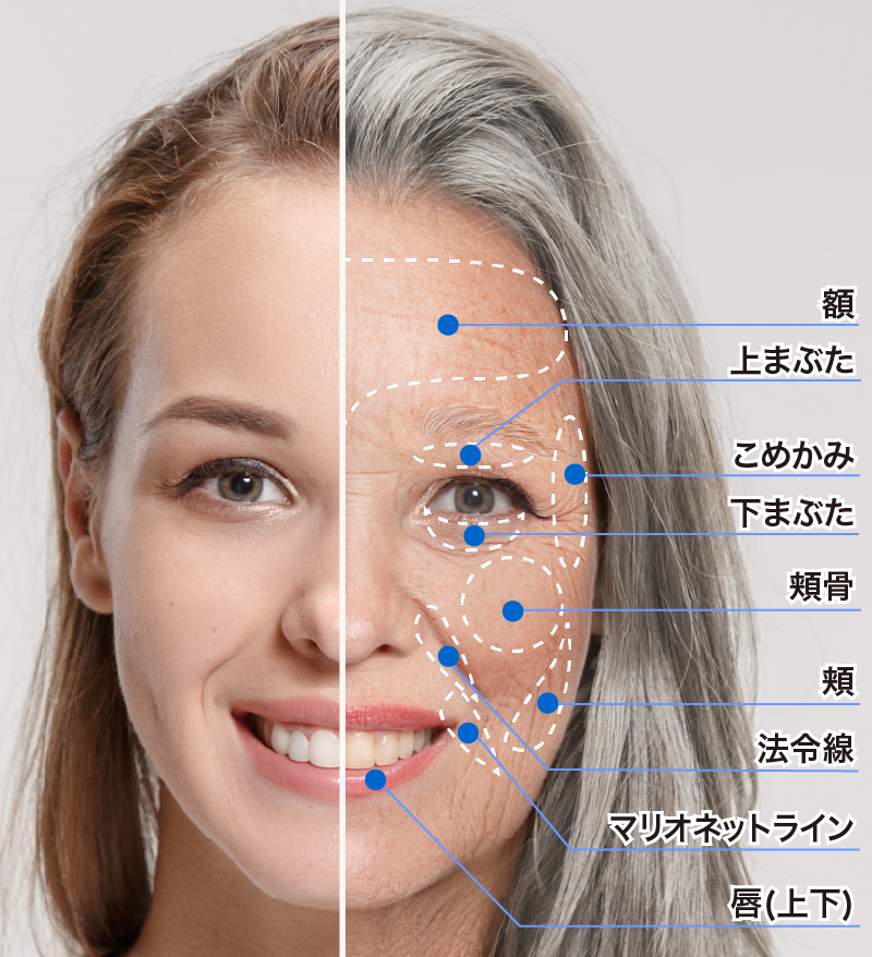 高濃度脂肪注入が応用できる場所の模式図