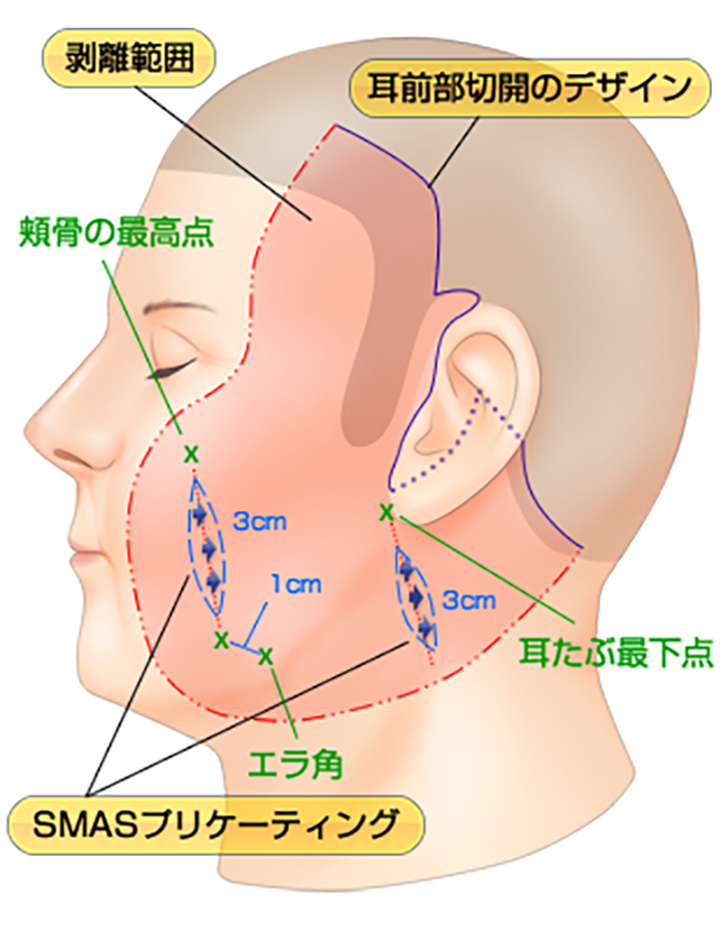 耳前部切開のデザインによる剥離範囲とSMASプリケーティングの位置