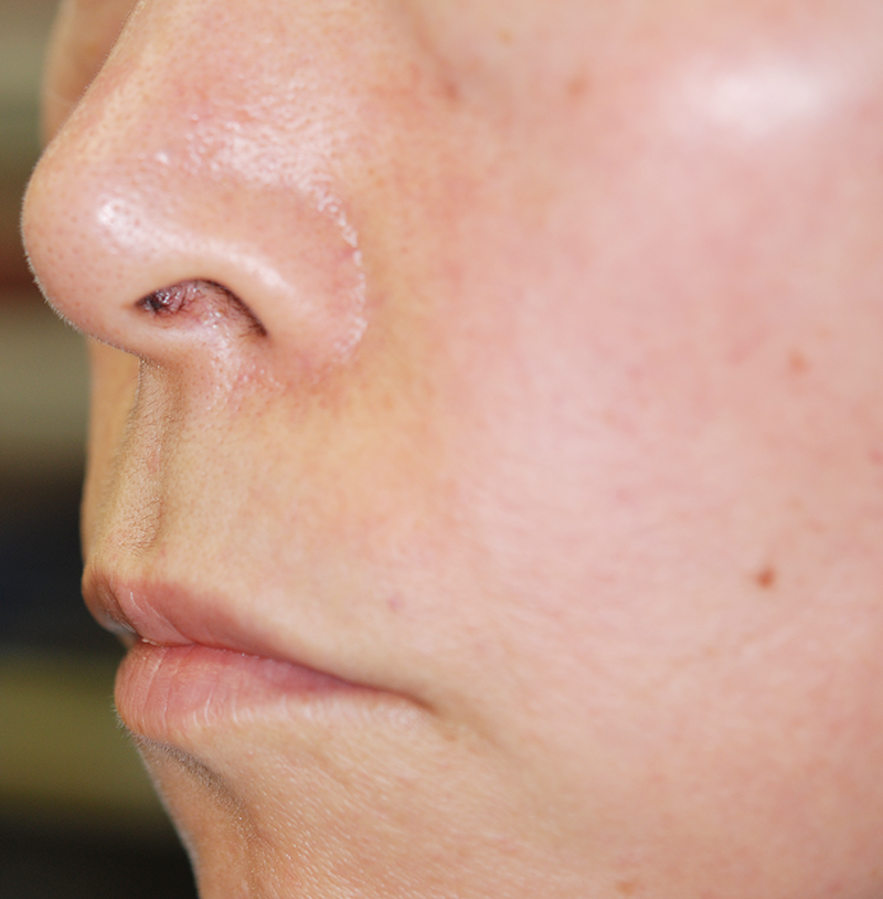 鼻の下を短くする手術(人中短縮術)の術前症例