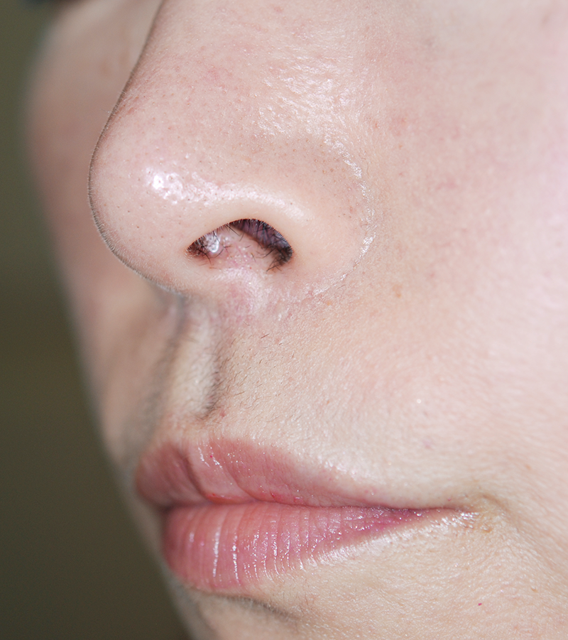 鼻の下を短くする(人中短縮術)の術後症例