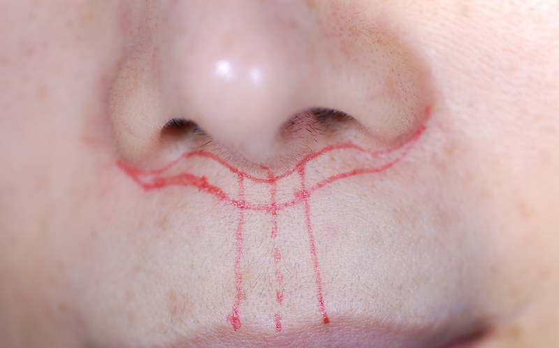 鼻の下を短くする手術(人中短縮術)のデザイン