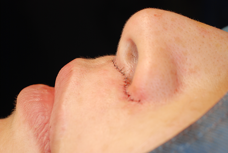 鼻の下を短くするの縫合後の状態(側面)