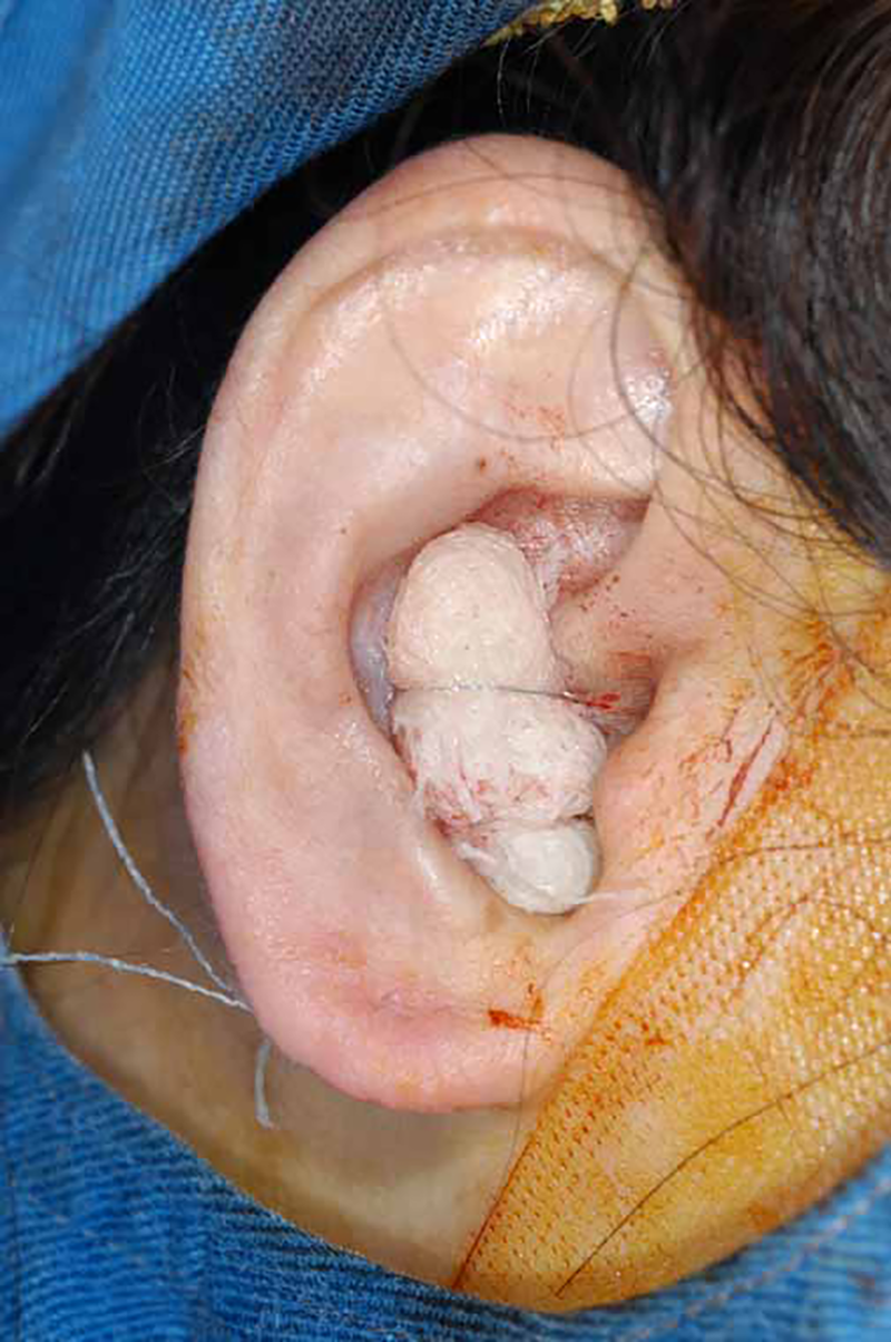 耳は縫合した後にタイオーバーで変形を防ぎます