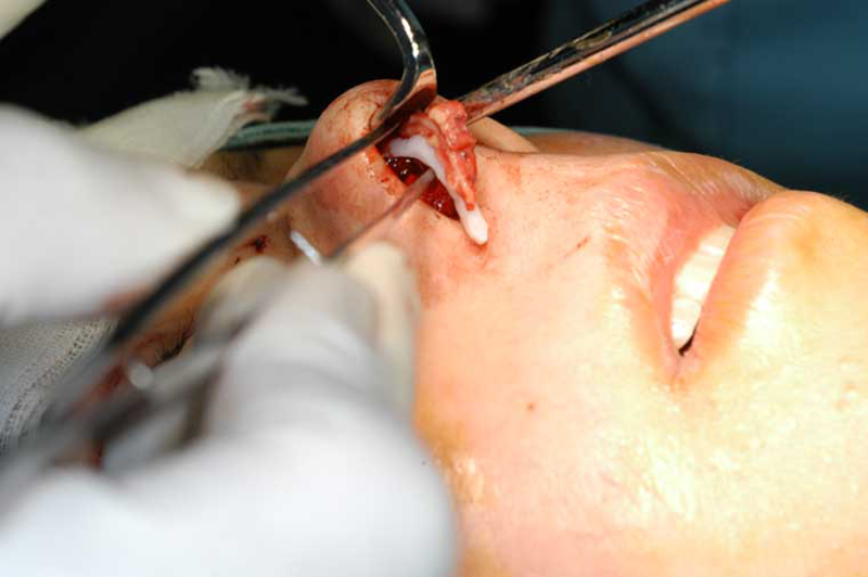 鼻根部では骨膜下、鼻柱基部では左右の鼻翼軟骨の間にプロテーゼを固定