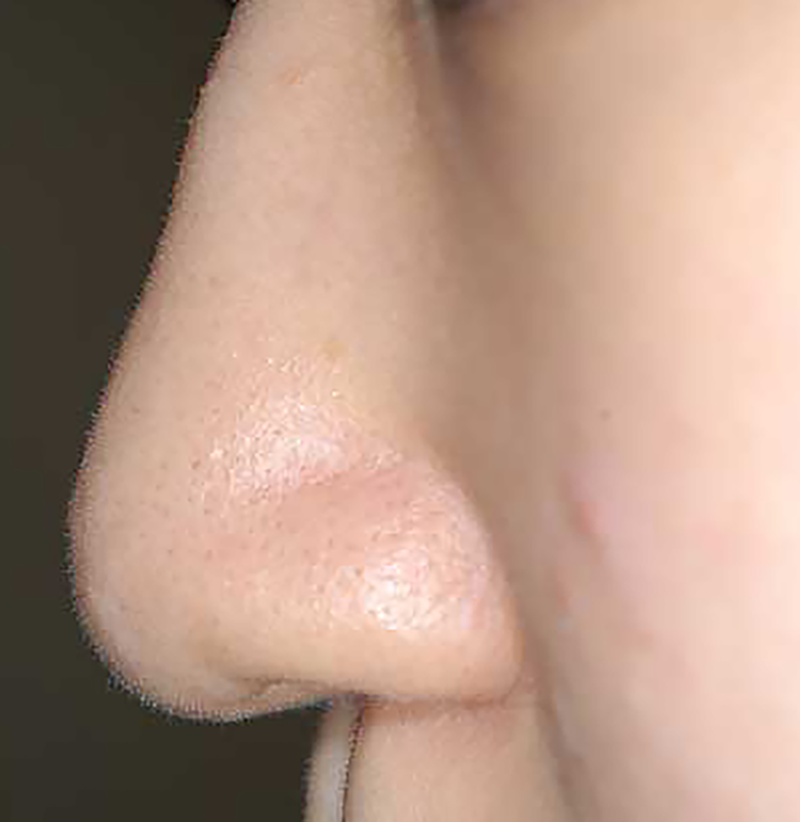 鼻尖軟骨形成手術の術前症例