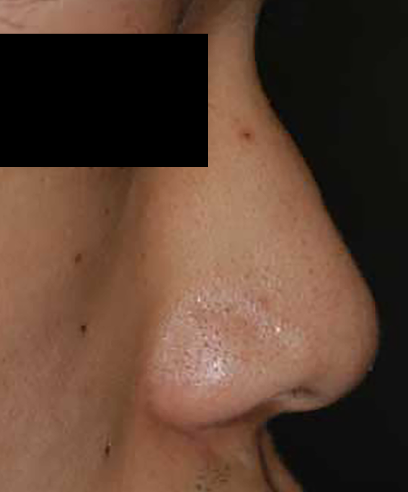 人工骨(ハイドロキシアパタイト)を使用した隆鼻手術の術前症例