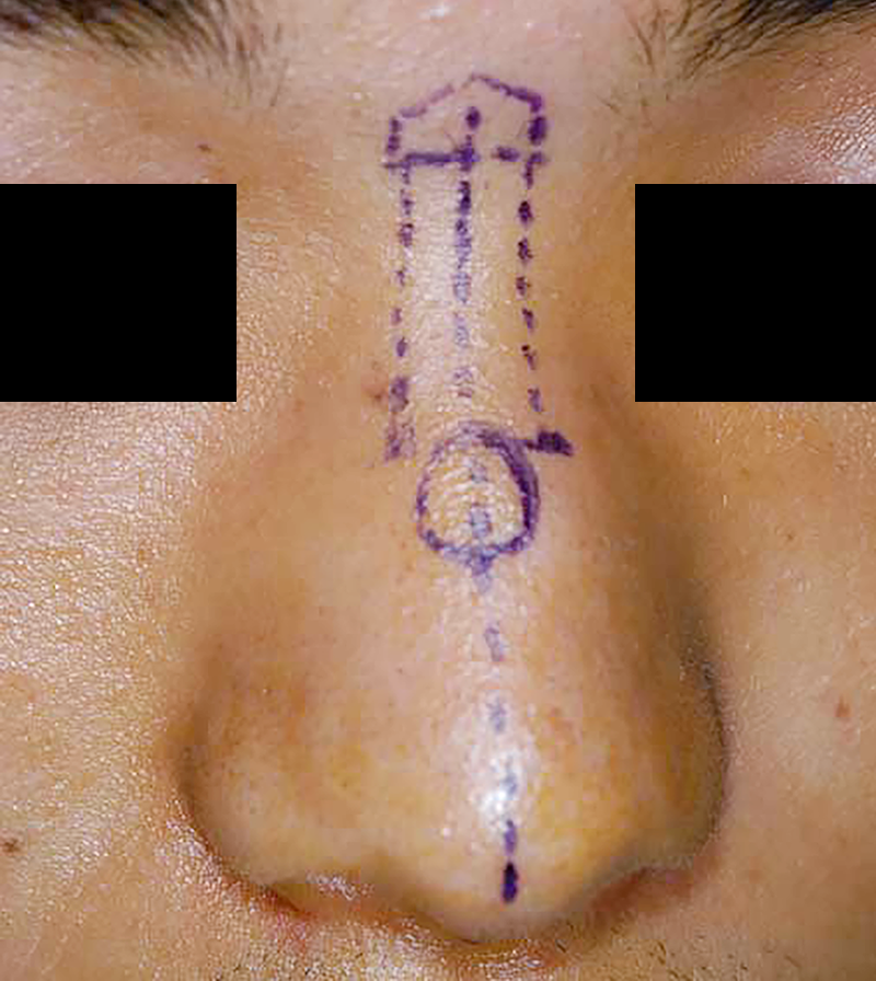人工骨の鼻への挿入予定位置