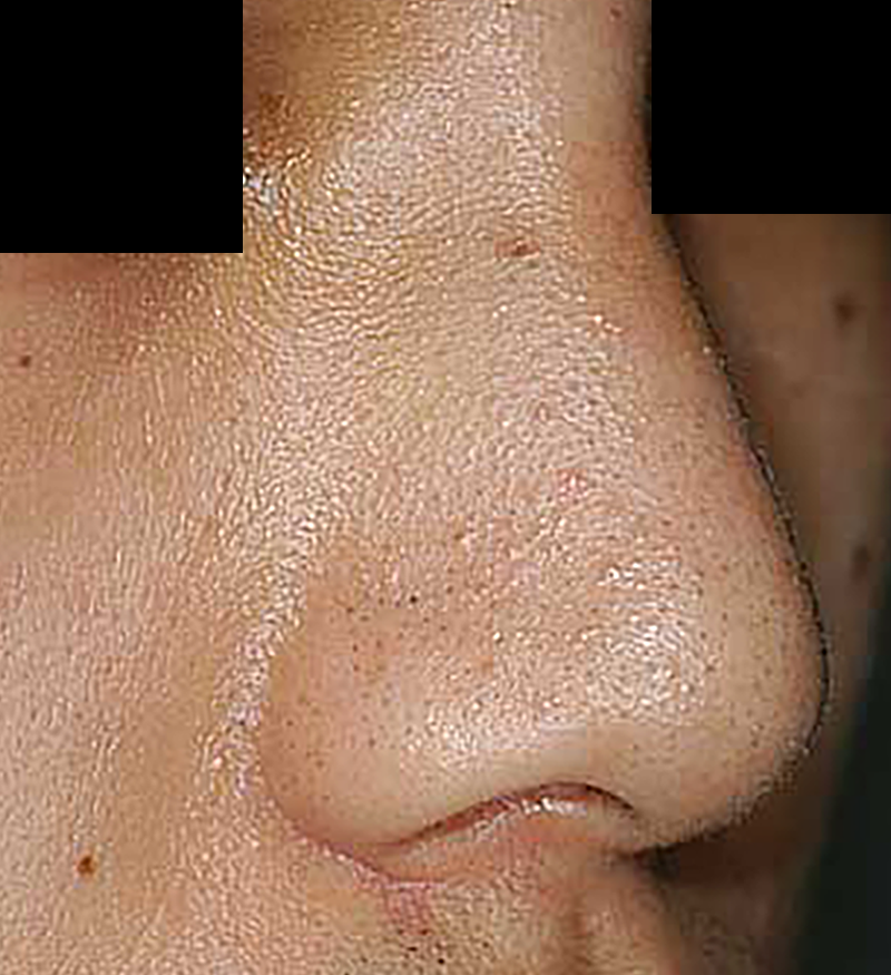 人工骨(ハイドロキシアパタイト)を使用した隆鼻手術の術後症例