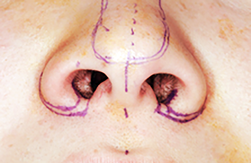 鼻翼形成(小鼻を小さく)の術前症例