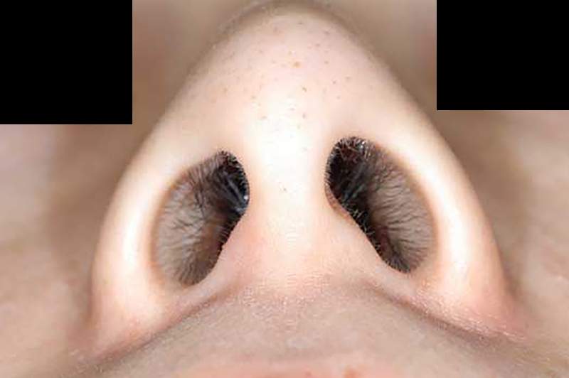 鼻翼形成(小鼻を小さく)の術前症例
