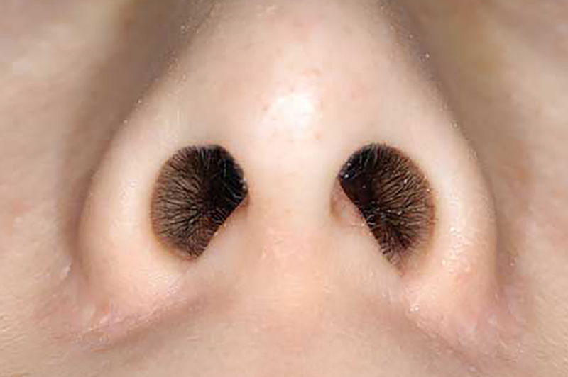 鼻翼形成(小鼻を小さく)の術後症例