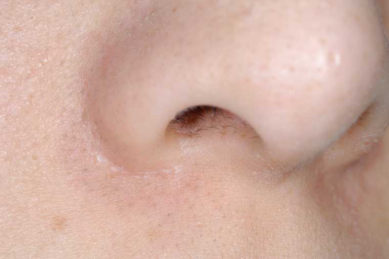鼻翼形成(小鼻を小さく)の術後の傷痕の状態