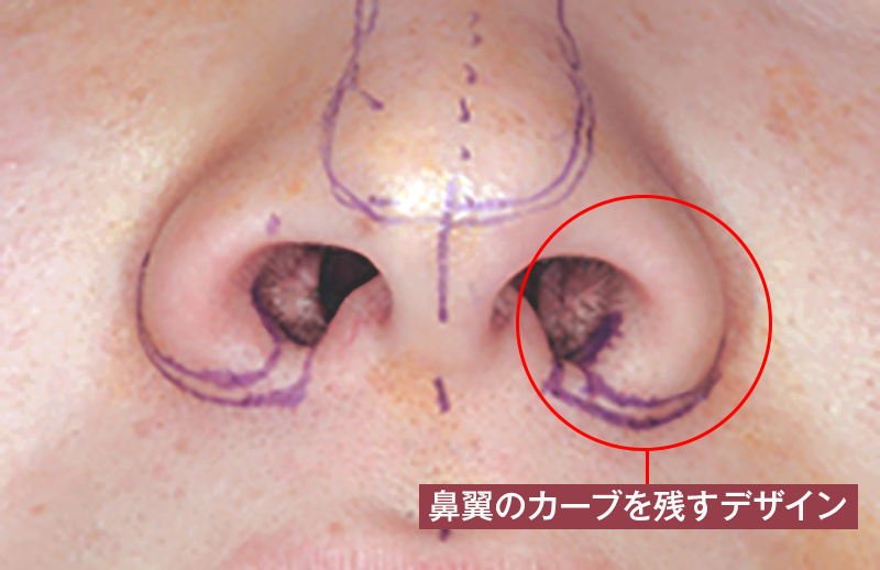 鼻翼形成(小鼻を小さく) デザイン