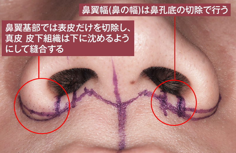 鼻翼形成(小鼻を小さく) デザイン