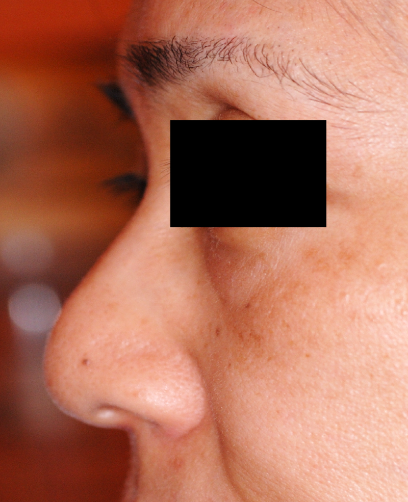 プロテーゼと耳介軟骨による隆鼻術の術前