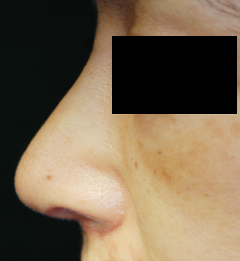プロテーゼと耳介軟骨による隆鼻術の術後6カ月の症例