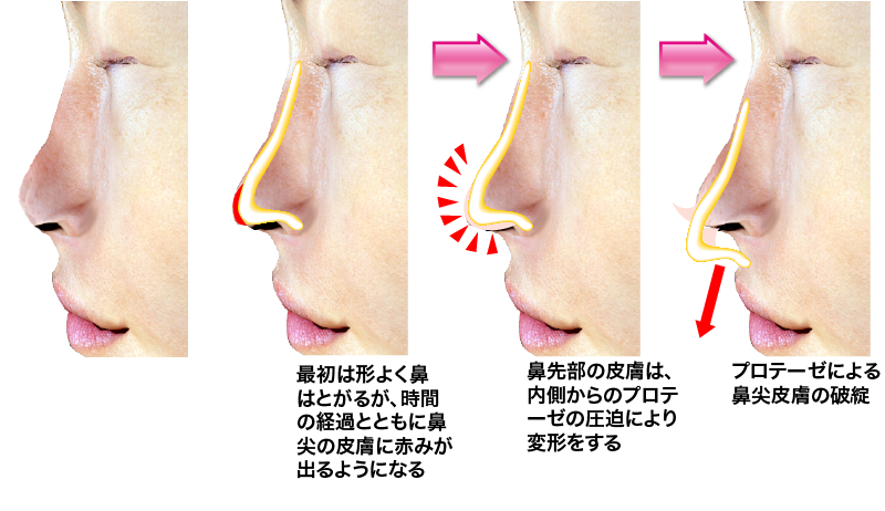最初は形良く鼻は尖るが時間の経過とともに鼻尖の皮膚に赤みが出るようになり、プロテーゼによる鼻尖皮膚の破綻