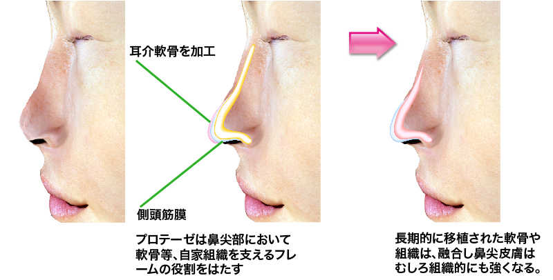 プロテーゼは鼻尖部において軟骨など、自家組織を支えるフレームの役割をはたす
