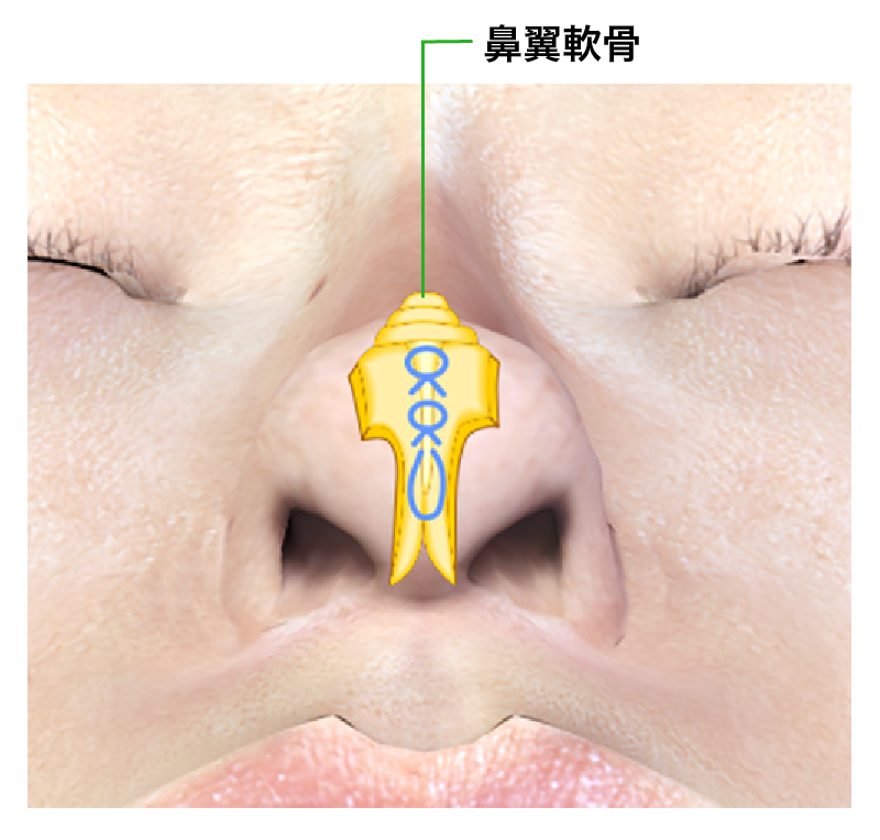 耳介軟骨を両側の鼻翼軟骨の間に移植し、鼻尖を尖らす