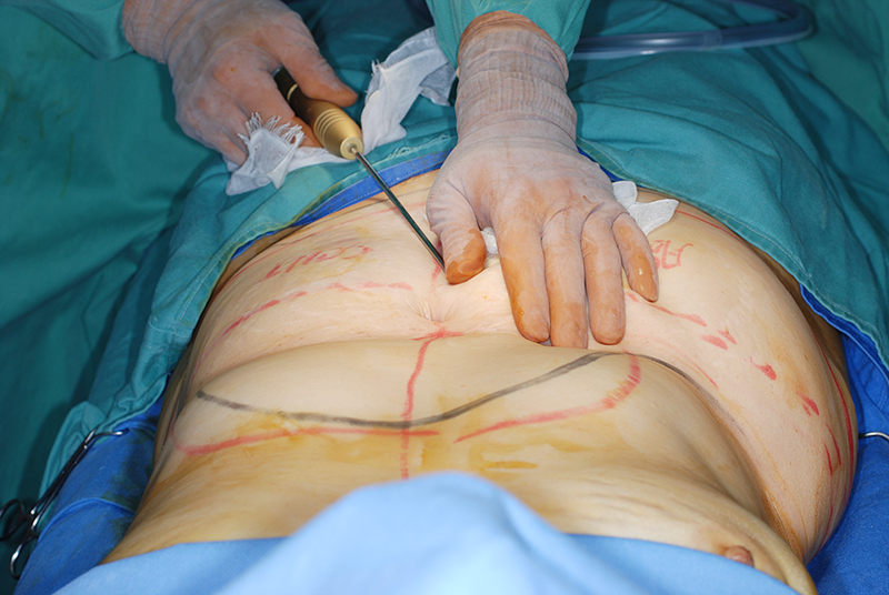 腹部脂肪吸引手術の術中の様子