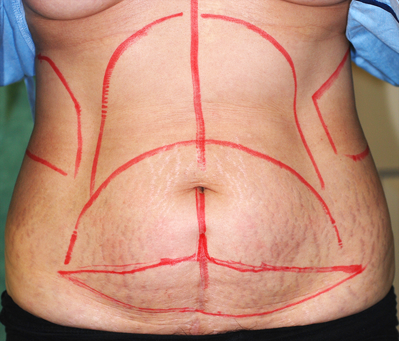 下腹部の切開による腹部リダクションのデザイン例