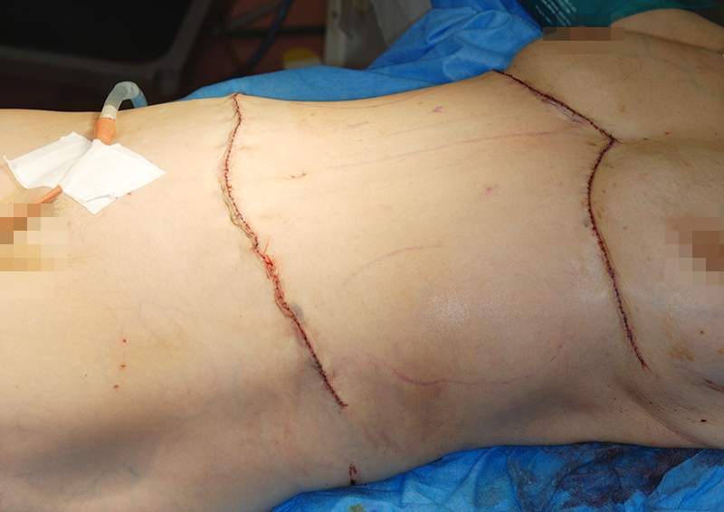下腹部と上腹部の同時切開による術後症例